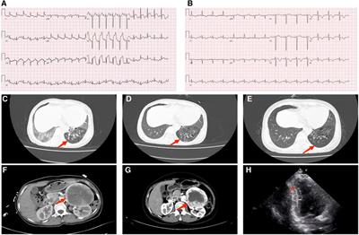 A case report and literature review: pheochromocytoma-mediated takotsubo cardiomyopathy, which is similar to acute myocardial infarction